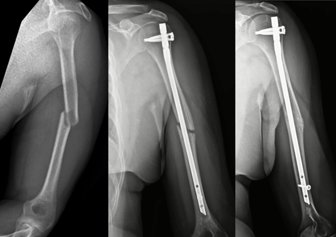 X-rays showing a 48-year-old with unstable displaced humerus fracture: injury, nail insertion, and healed fracture